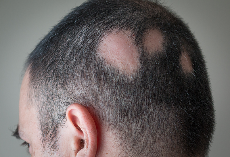 A man with alopecia areata shows the back of his head where there are several bald patches from the autoimmune disease.