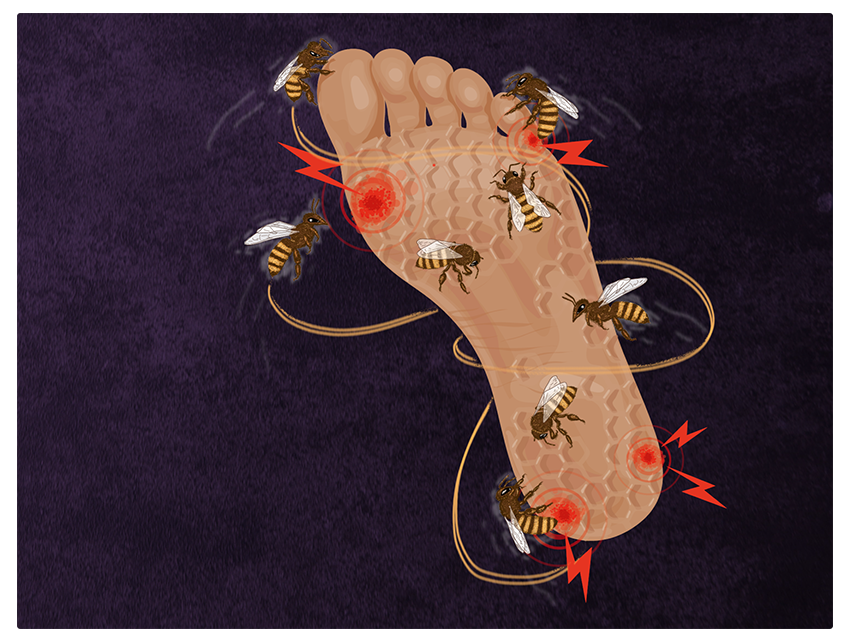 An illustration of what diabetic peripheral neuralgia feels like shows a foot being stung by bees over and over again.