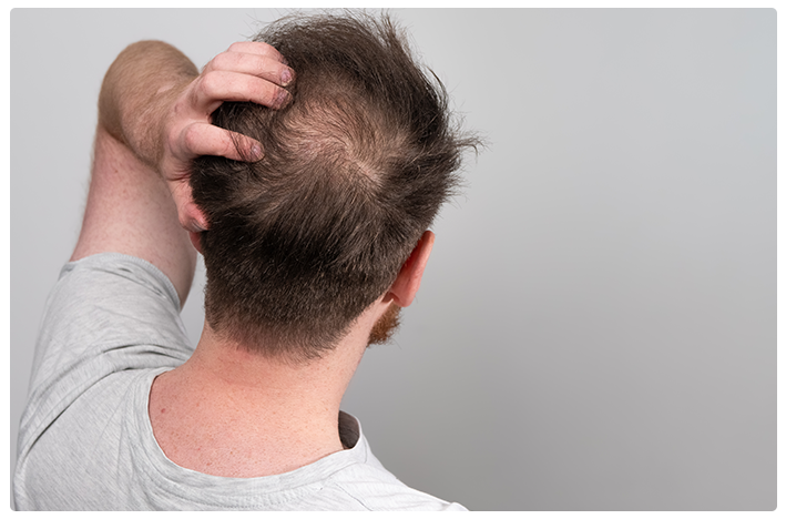 A man with male pattern baldness (Androgenetic Alopecia) combs through his hair to inspect the thinning hair on the back of his head.