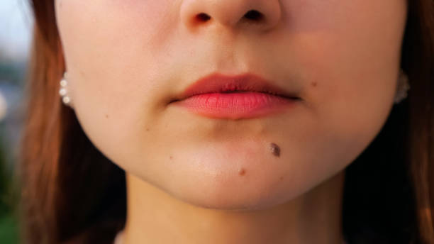 Warts research study