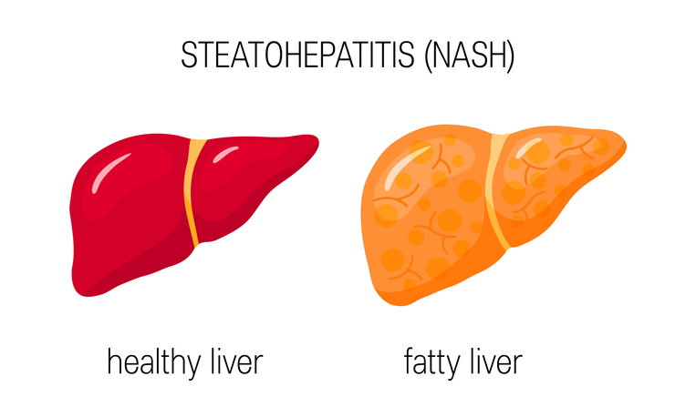Non-alcoholic steatohepatitis research study