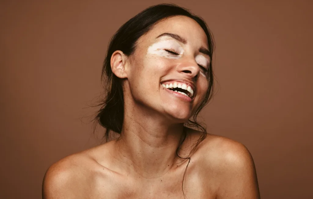 vitiligo research study